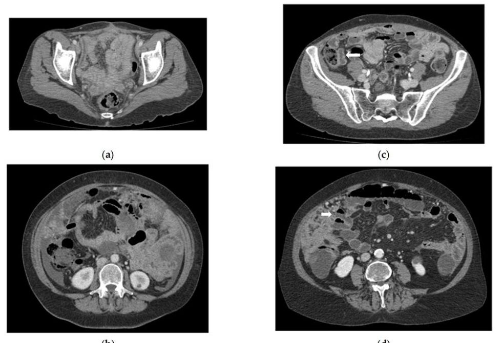 Ct Enterography For Preoperative Evaluation Of Peritoneal Carcinomatosis Index In Advanced 